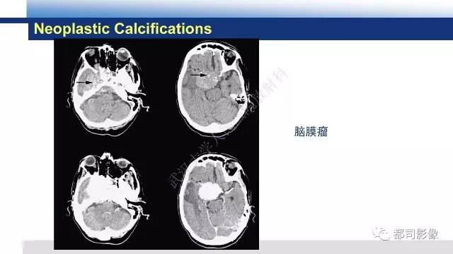 【PPT】Fahr's综合征
