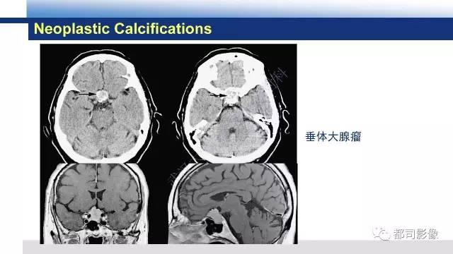 【PPT】Fahr's综合征