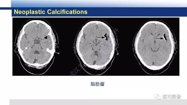 【PPT】Fahr's综合征