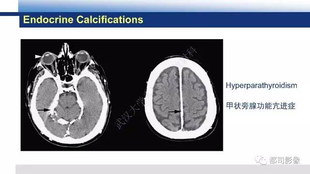【PPT】Fahr's综合征