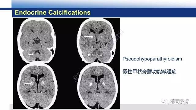 【PPT】Fahr's综合征