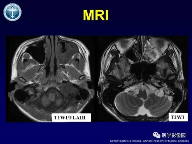 【病例】左侧颈静脉孔区脊索瘤1例MR影像表现