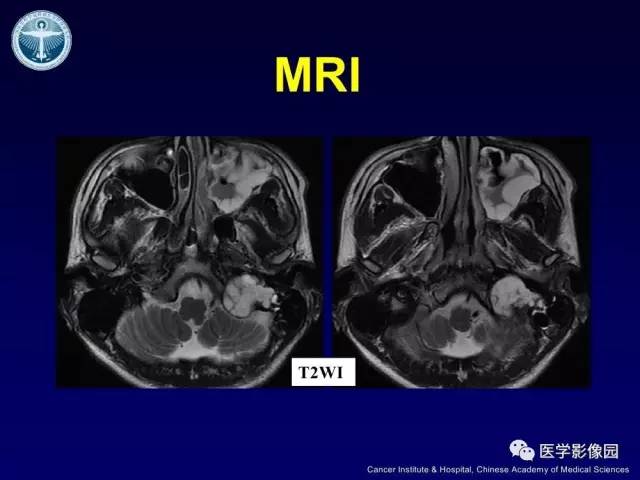 【病例】左侧颈静脉孔区脊索瘤1例MR影像表现