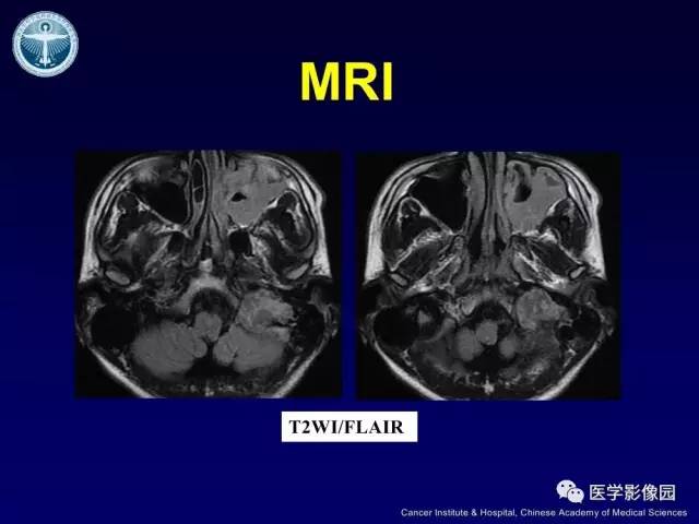 【病例】左侧颈静脉孔区脊索瘤1例MR影像表现
