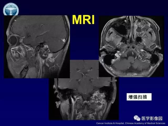 【病例】左侧颈静脉孔区脊索瘤1例MR影像表现