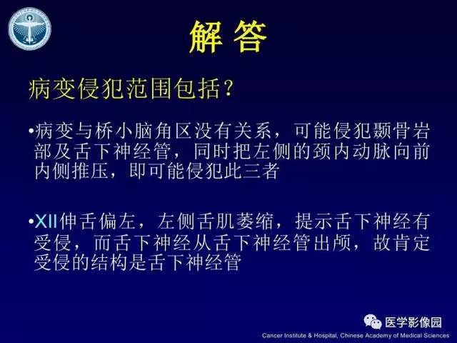 【病例】左侧颈静脉孔区脊索瘤1例MR影像表现