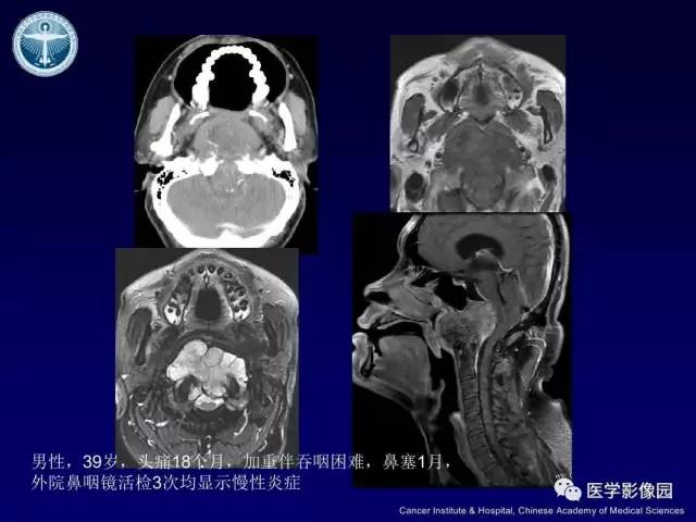 【病例】左侧颈静脉孔区脊索瘤1例MR影像表现