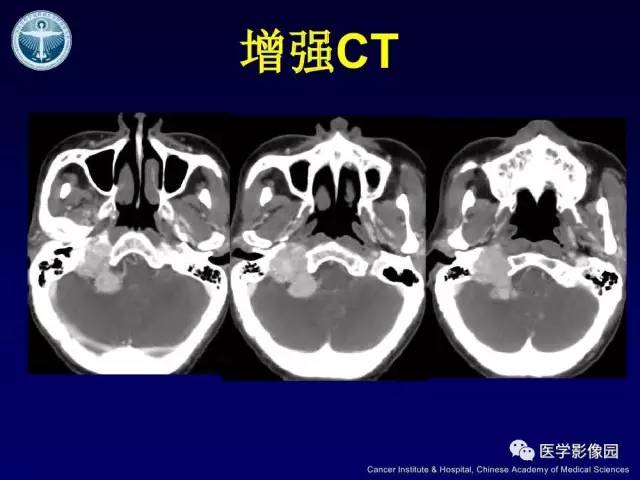 【病例】右侧颈静脉孔区副神经节瘤1例CT影像表现