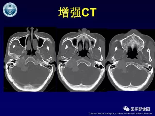 【病例】右侧颈静脉孔区副神经节瘤1例CT影像表现