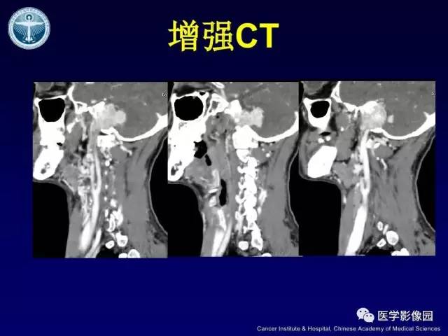 【病例】右侧颈静脉孔区副神经节瘤1例CT影像表现