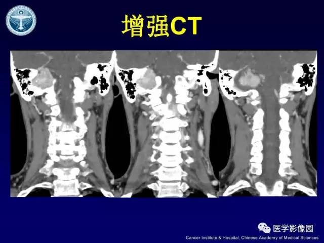 【病例】右侧颈静脉孔区副神经节瘤1例CT影像表现