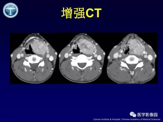【病例】右侧颈静脉孔区副神经节瘤1例CT影像表现