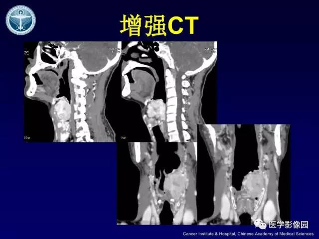 【病例】右侧颈静脉孔区副神经节瘤1例CT影像表现