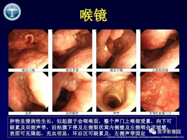 【病例】右侧颈静脉孔区副神经节瘤1例CT影像表现