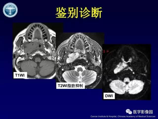 【病例】右侧颈静脉孔区副神经节瘤1例CT影像表现