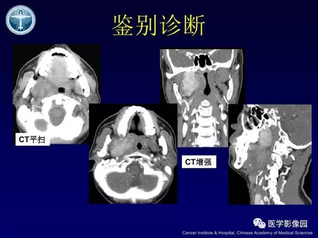 【病例】右侧颈静脉孔区副神经节瘤1例CT影像表现