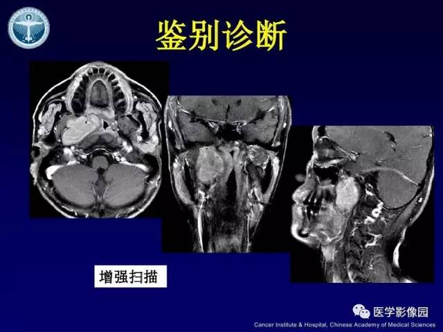 【病例】右侧颈静脉孔区副神经节瘤1例CT影像表现