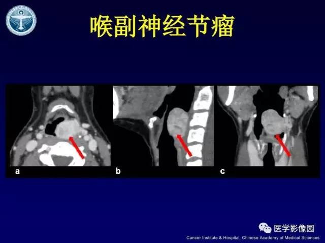 【病例】右侧颈静脉孔区副神经节瘤1例CT影像表现