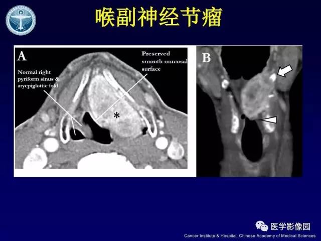 【病例】右侧颈静脉孔区副神经节瘤1例CT影像表现