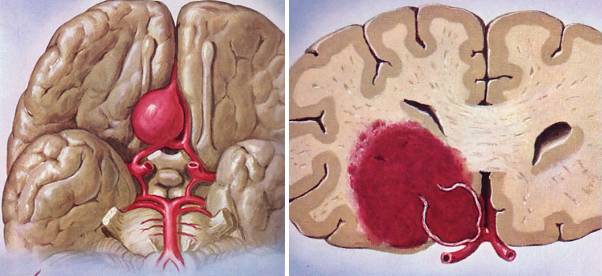 脑子里的定时炸弹——颅内动脉瘤