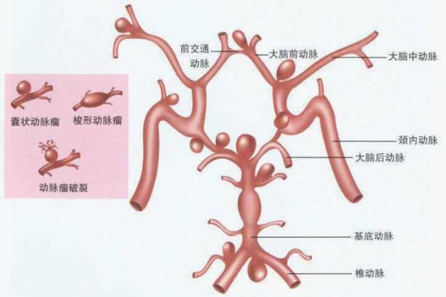 脑子里的定时炸弹——颅内动脉瘤