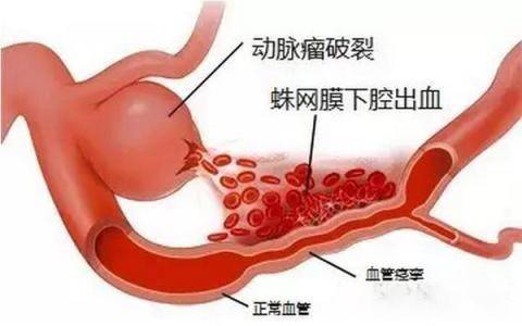 脑子里的定时炸弹——颅内动脉瘤