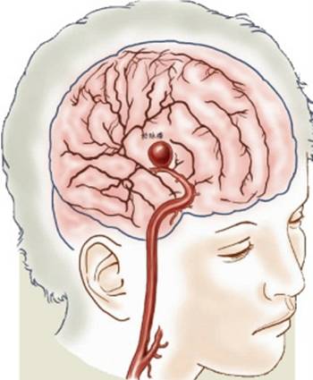 脑子里的定时炸弹——颅内动脉瘤