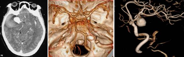 脑子里的定时炸弹——颅内动脉瘤