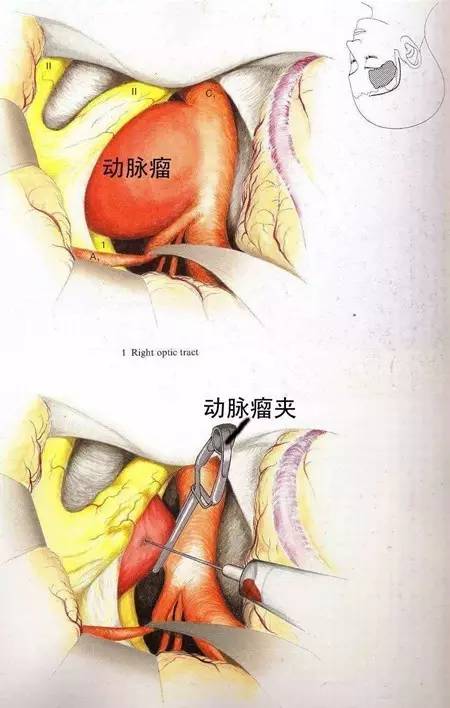 脑子里的定时炸弹——颅内动脉瘤