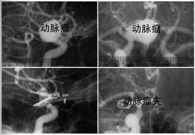 脑子里的定时炸弹——颅内动脉瘤