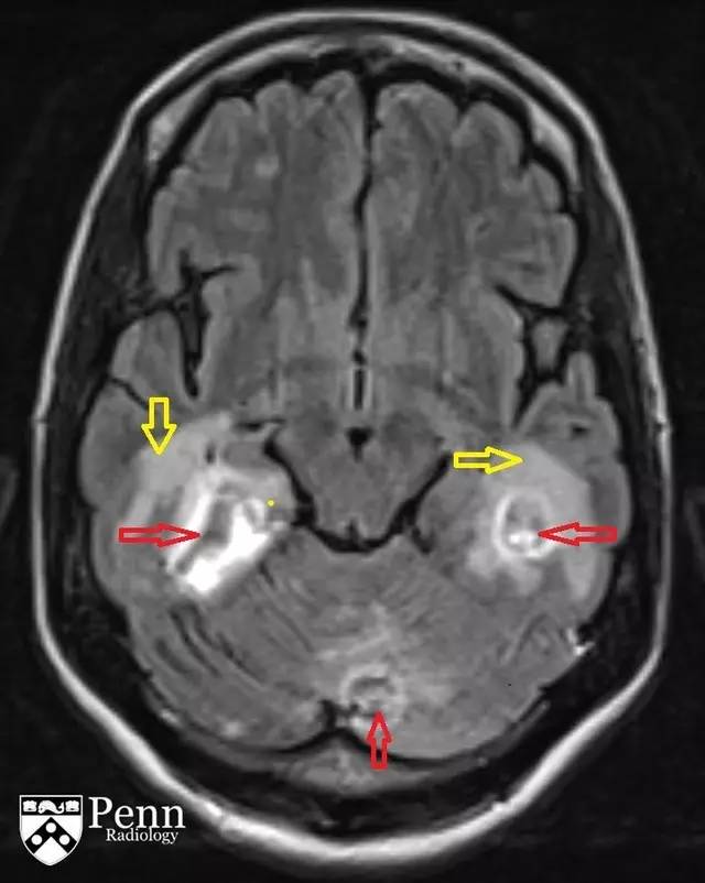【病例】脑弓形虫病1例CT及MR影像诊断要点