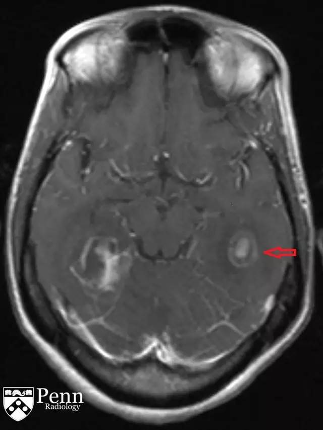 【病例】脑弓形虫病1例CT及MR影像诊断要点