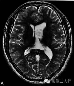 【病例】室管膜下瘤1例CT及MR影像表现分析