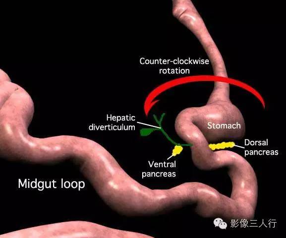 先天性背胰缺如 Dorsal pancreatic agenesis