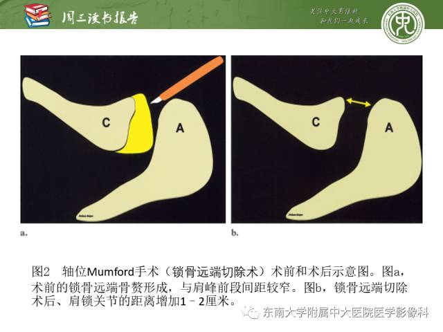 【PPT】术后肩关节MR及MR关节成像-正常与异常影像表现