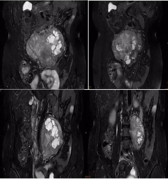 【病例】腹膜后副神经节瘤1例MR影像表现
