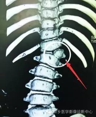 脊椎椎体畸形（半椎体、蝴蝶椎）