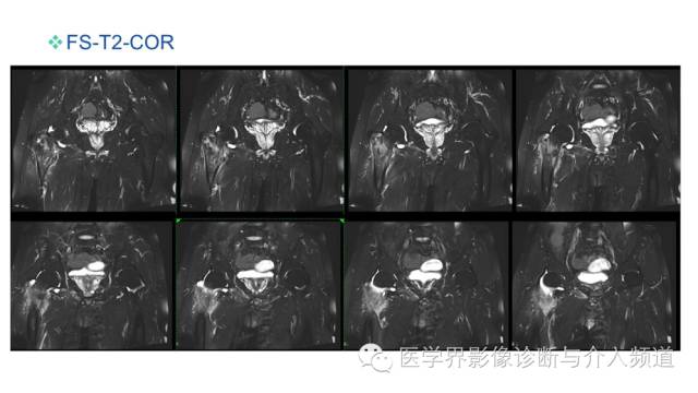 【病例】骨样骨瘤1例MR影像表现