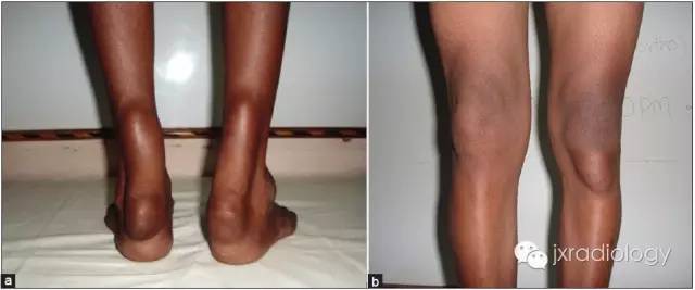 跟腱黄色瘤 Achilles tendon xanthoma