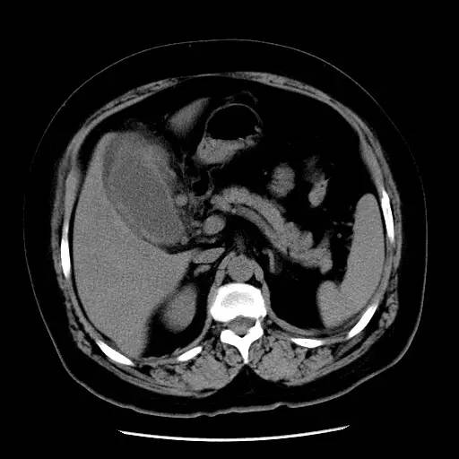 【病例】胆囊癌1例CT影像表现