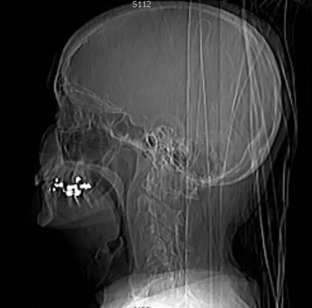 【病例】II型齿状突骨折1例