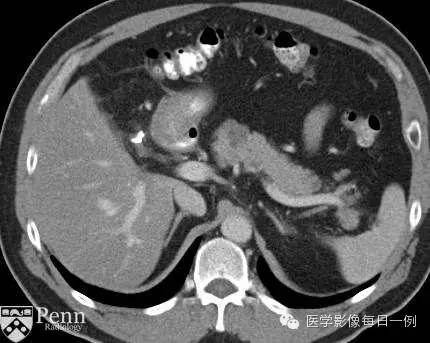 【病例】典型胰腺多囊浆液性囊腺瘤1例CT MR影像表现