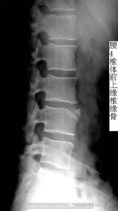 椎缘骨/软骨结节，一个偶尔会遇到的疾病