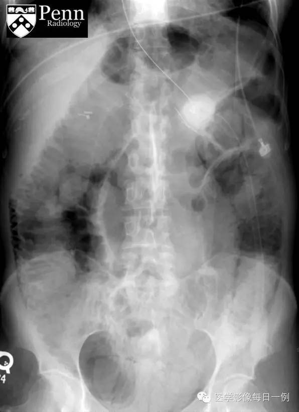 【病例】肠壁积气1例影像表现