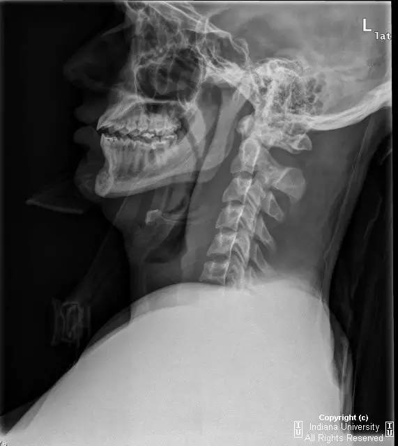 【病例】Jefferson骨折1例X线CT及MR影像表现
