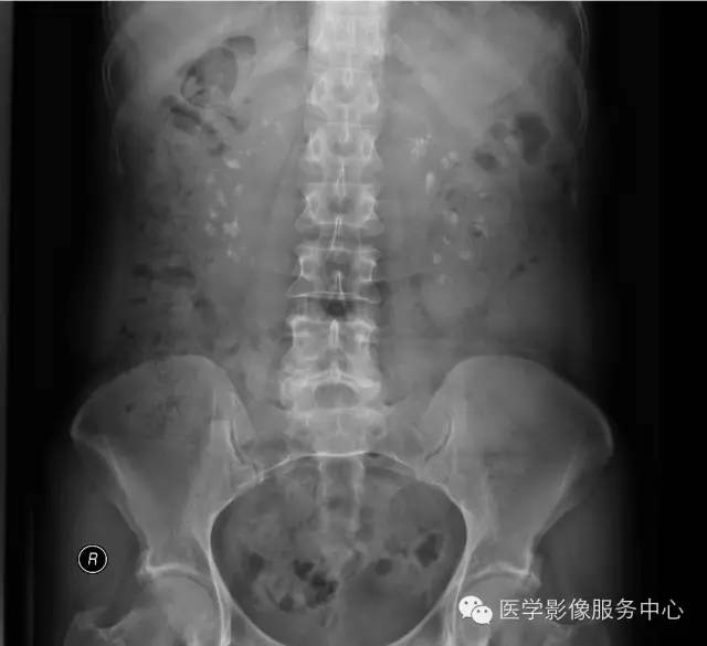 【病例】双侧髓质海绵肾1例CT影像诊断与鉴别