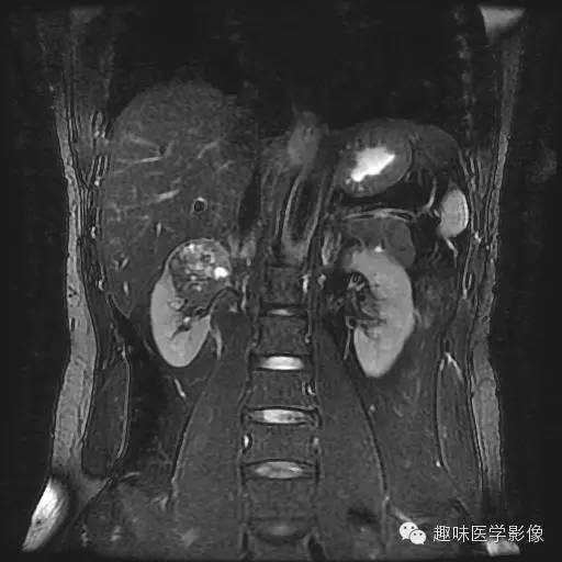 【病例】肾细胞癌1例MR影像表现