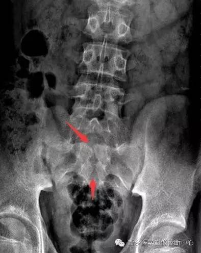脊柱裂——隐性脊柱裂、脊膜膨出、脊髓脊膜膨出