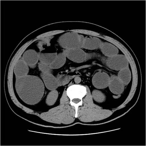 【病例】结肠癌1例CT影像表现