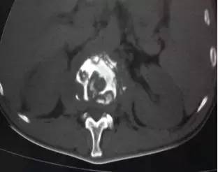 【病例】腰椎结核1例CT影像表现